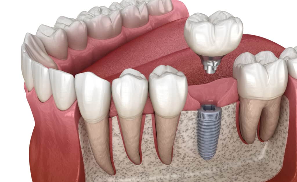 How the Right Mouthwash Can Extend Dental Implant Longevity