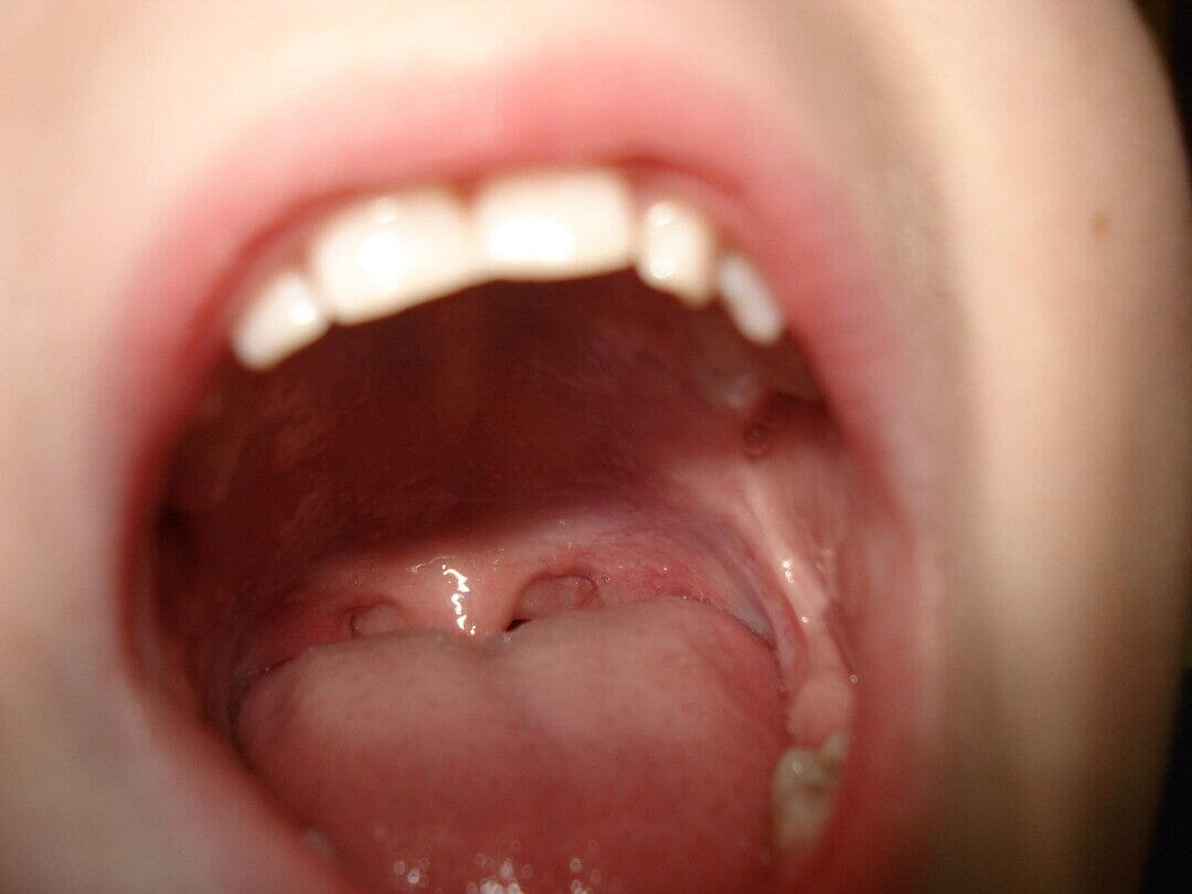 Understanding Tonsil Stones & Benefits of Sea Salt Mouthwash